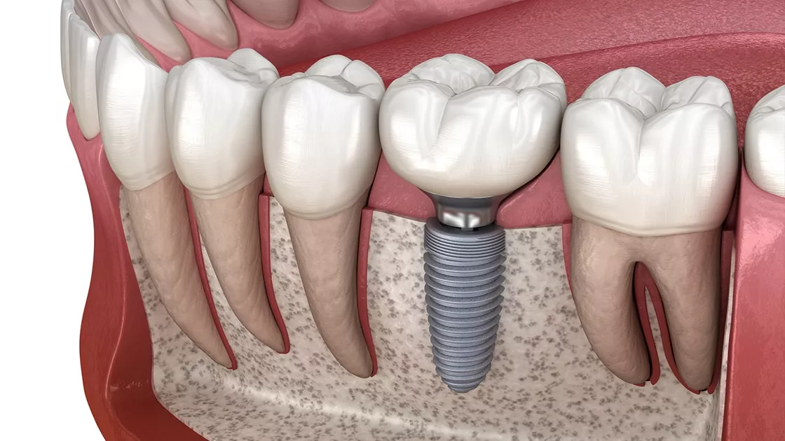 Implants dentaires: Tout savoir