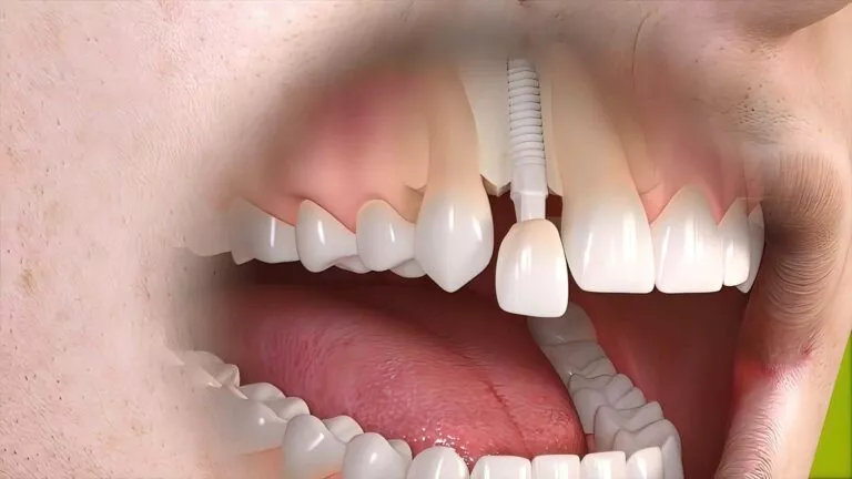 Bridge dentaire vs implant: quelles différences?