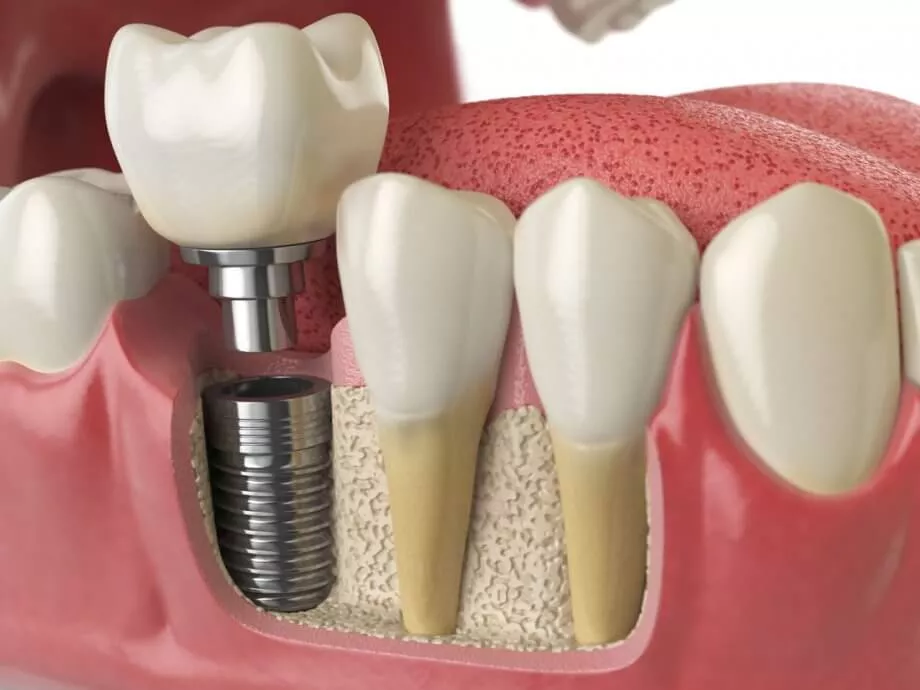 Implants dentaires: avantages et inconvénients