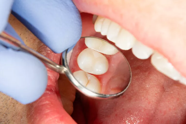 Scellants dentaires pour enfants: Avantages, Inconvénients et Sécurité