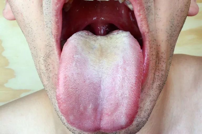 Causes du goût amer dans la bouche