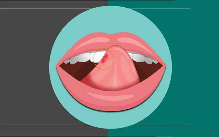 Blister de sang dans la bouche: causes et remèdes