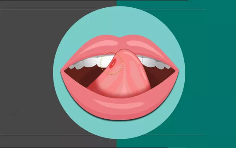 Blister de sang dans la bouche: causes et remèdes