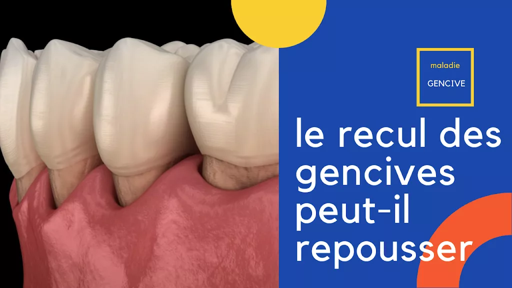 recul 2Bdes 2Bgencives 2Bpeut il 2Brepousser.png