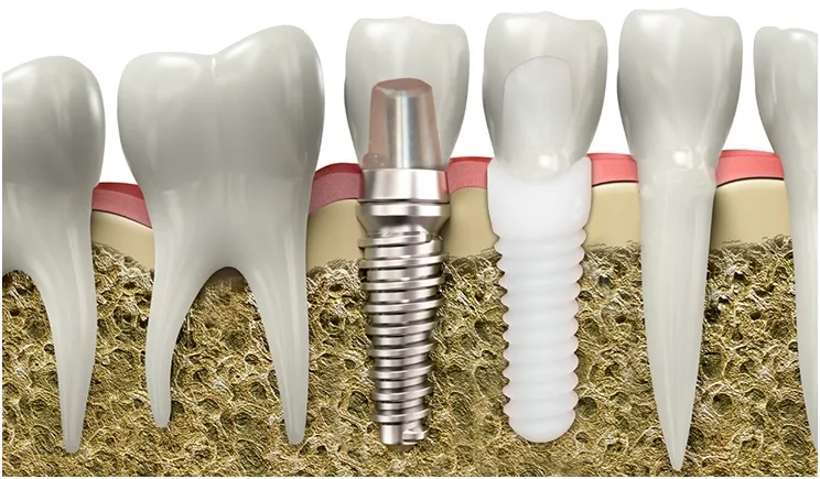 Implants en zircone: avantages et inconvénients