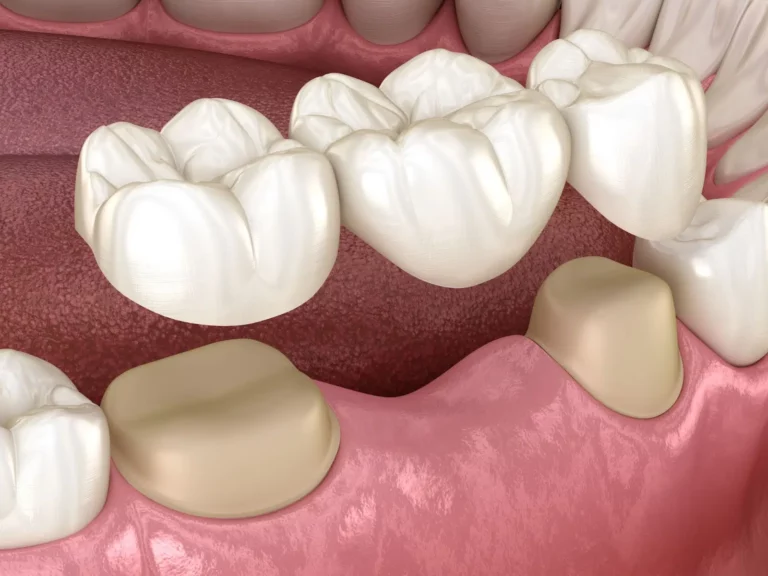 Bridges dentaires: types et qui en a besoin