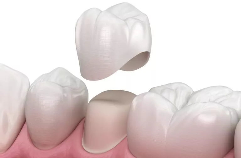 Couronnes dentaires: types, procédure et soins