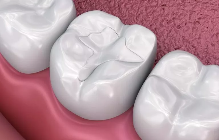 Les scellants dentaires